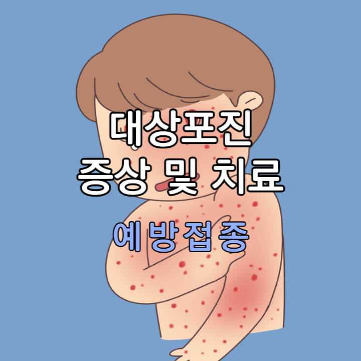 대상포진-대표사진