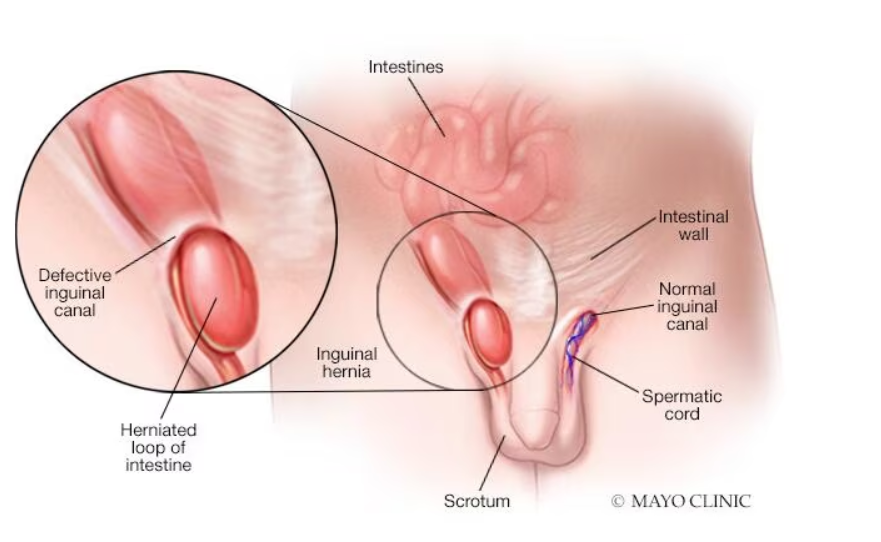 https://www.mayoclinic.org/diseases-conditions/inguinal-hernia/symptoms-causes/syc-20351547