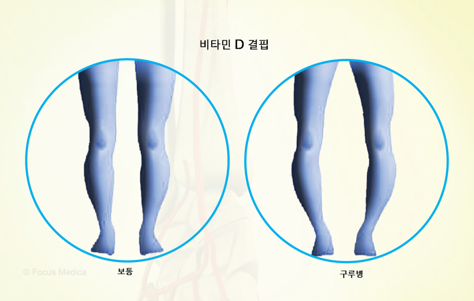 비타민 D와 구루병