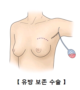 유방 이미지