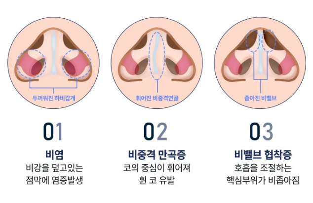 비염애 관한 이미지