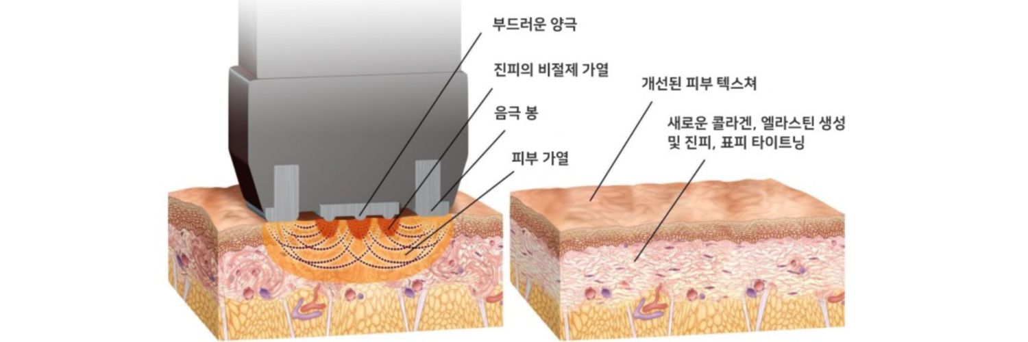 인모드 forma