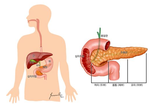  췌장암 초기증상 생존율이 지극히 낮은 이유는?