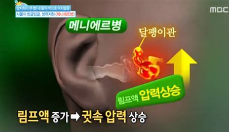  매니에르 증후군의 운동 법과 식이요법