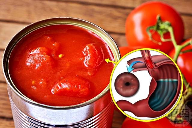 식도염에 나쁜 음식 : 토마토, 식도염 치료기간