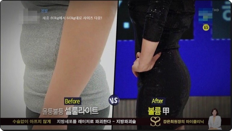 셀룰라이트 제거까지 지방파괴술 효과, 뱃살 다이어트부터 복부 5