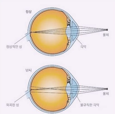 정상눈-의-각막과-난시의-불규칙한-각막-비교-사진