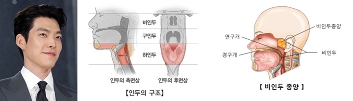 김우빈-두경부암과-비인두암
