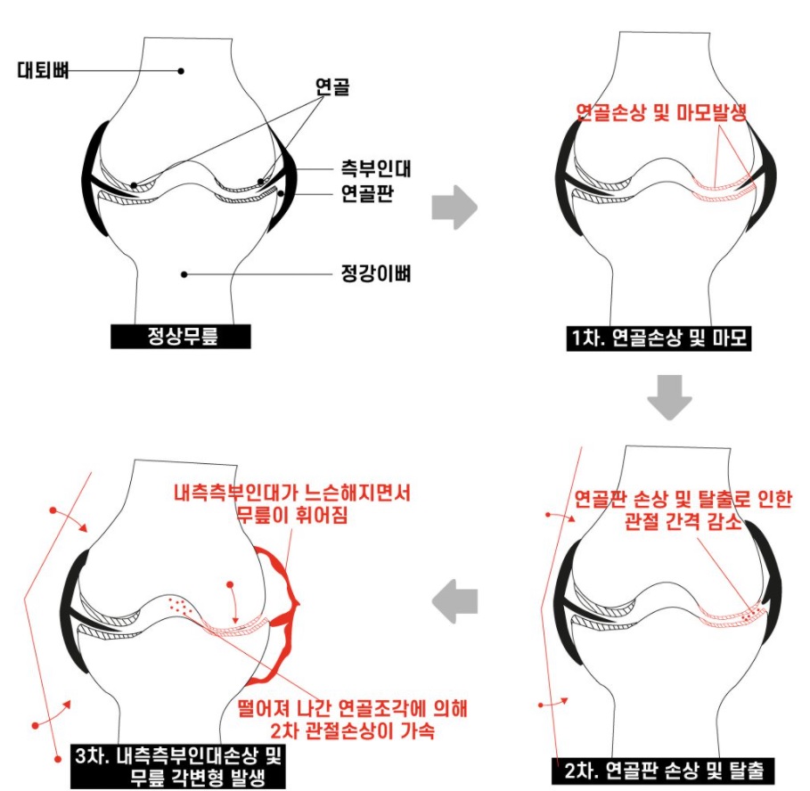  무릎 퇴행성 관절염 원인 증상 그리고 치료 방법