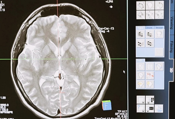 뇌 MRI 사진