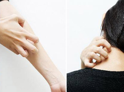  겨울철 참을 수 없는 간지러움 콜린성 두드러기 원인과 극복 방안
