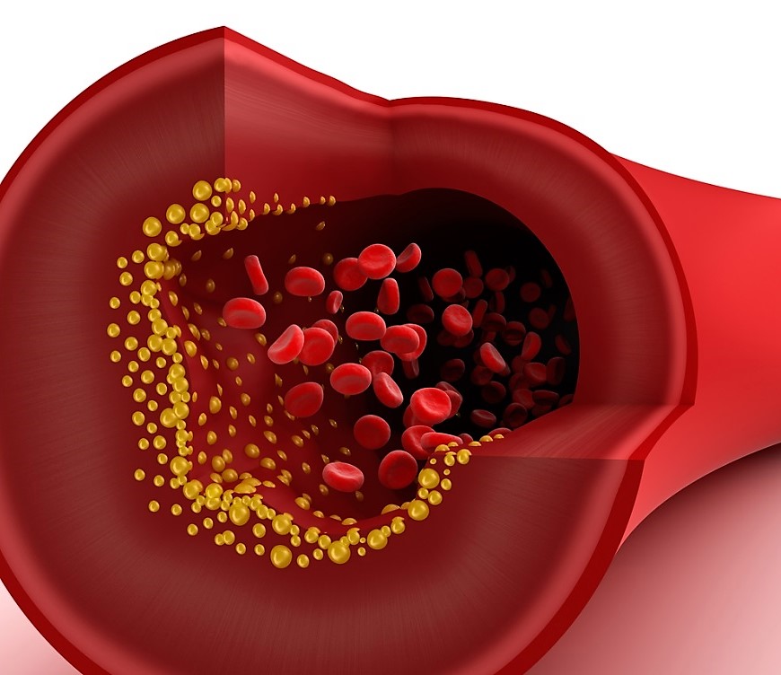 혈액내의 지방이 축적되는 무서운 고지혈증 이미지