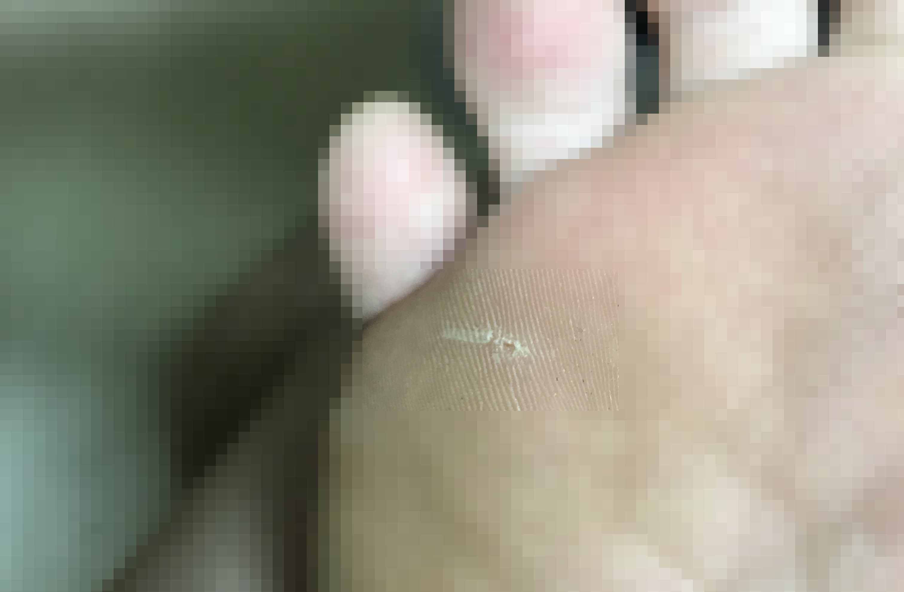  발바닥 앞 통증의 원인은 박힌 작은 유리 때문이였다니!