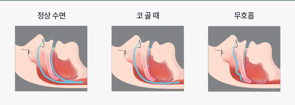 코골이
