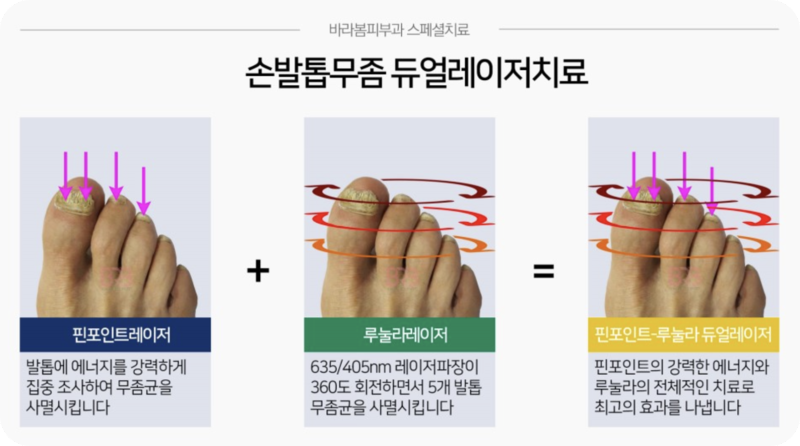 발톱무좀실비처리5