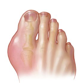 통풍증상사진