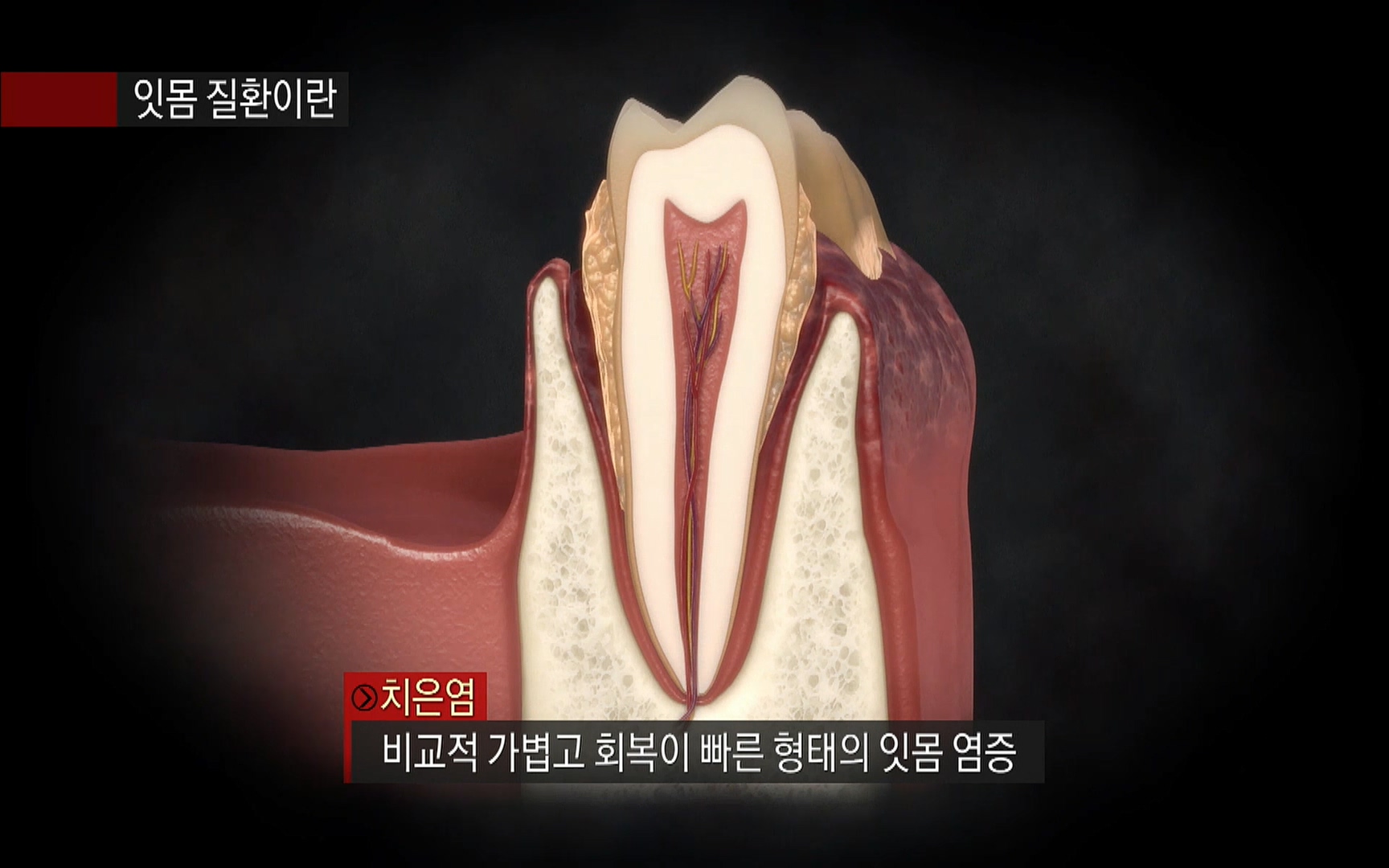 EBS 명의 헬스케어 - TV - 교육의 중심 EBS2015년 1월 16일 (금) 밤 9시 50분, EBS1.mp4_20220505_145112.292.jpg