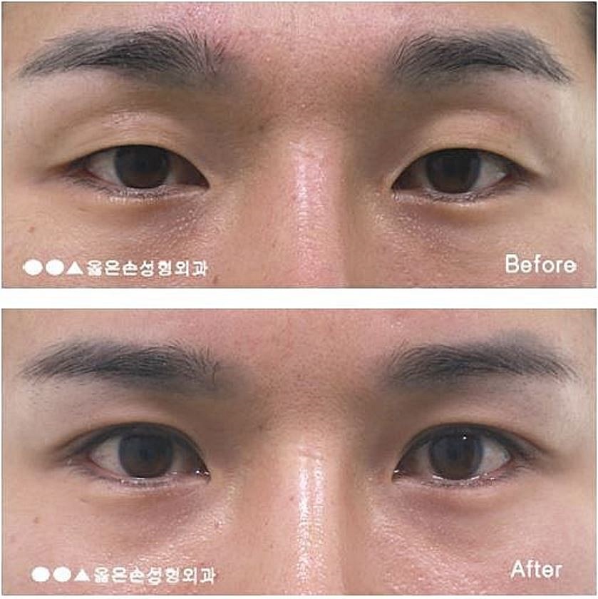 상안검 수술 후기 반드시 참고해야 한다 12