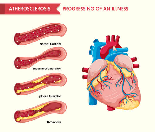 Heart-disease- infographics2