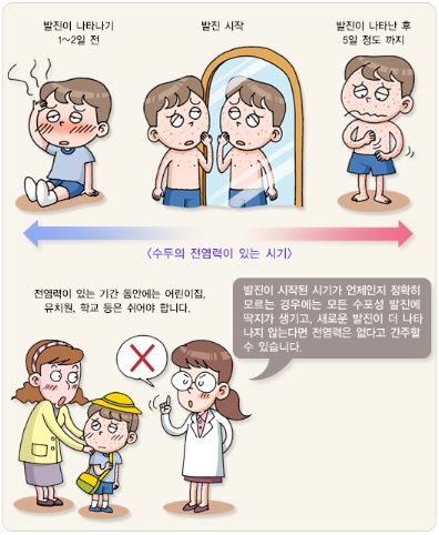 수두 전염력 시기