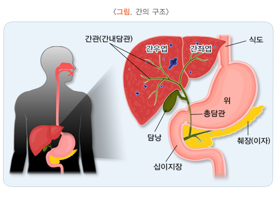  간경화증