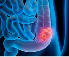 Preventing Colon Cancer among Younger Generations through Lifestyle Habits.