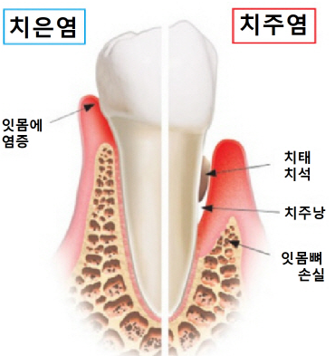 치주염