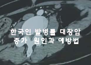  한국인 대장암 증가 원인에 대한 궁금증
