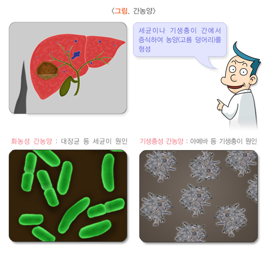  간농양