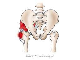 고관절 통증 치료법