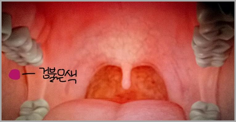 입안 피멍울 원인 치료방법