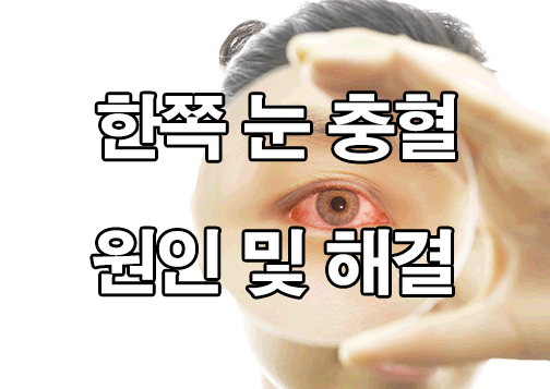  한쪽 눈 충혈 원인 및 해결 : 결막하출혈, 결막염