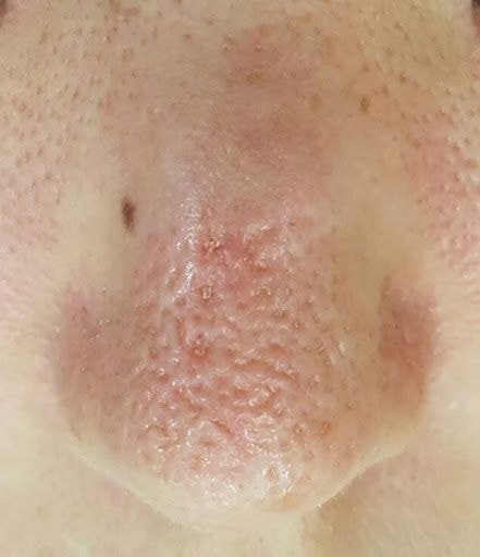  코 모공, 피부과에서도 가장 난감해 한다는 피부 유형.jpg