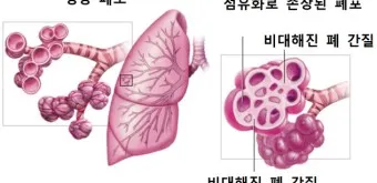 폐섬유증 초기 증상 치료법 관리방법_4