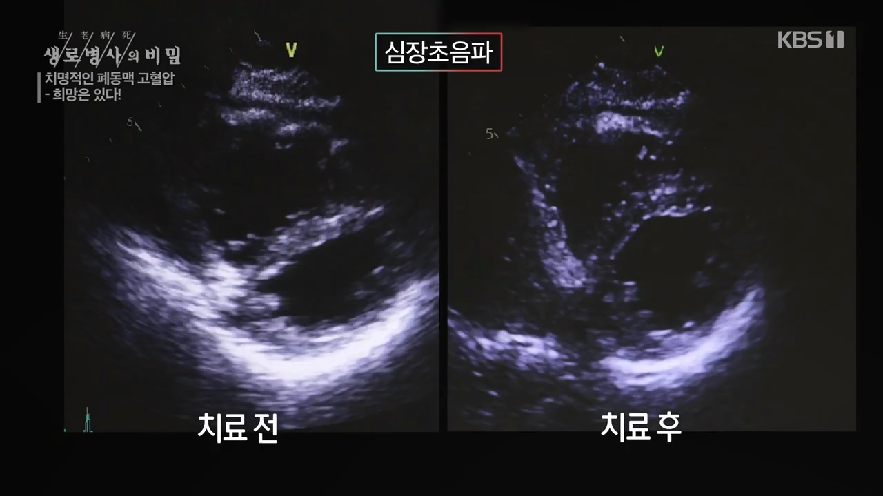 생로병사의 비밀.E900.240215p-NEXT.mp4_20240215_202907.108.jpg