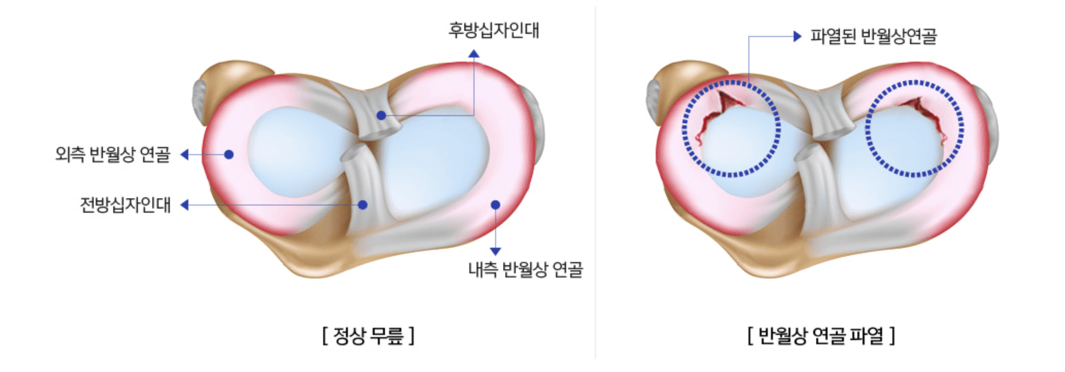 반월상 연골파열 증상 설명 사진