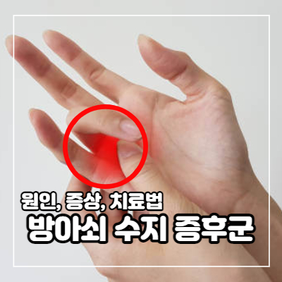 방아쇠 수지 증후군 원인과 증상 및 치료법