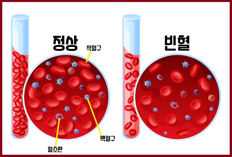 빈혈