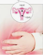  자궁내막증 증상 (7가지)와 수술 및 치료 방법