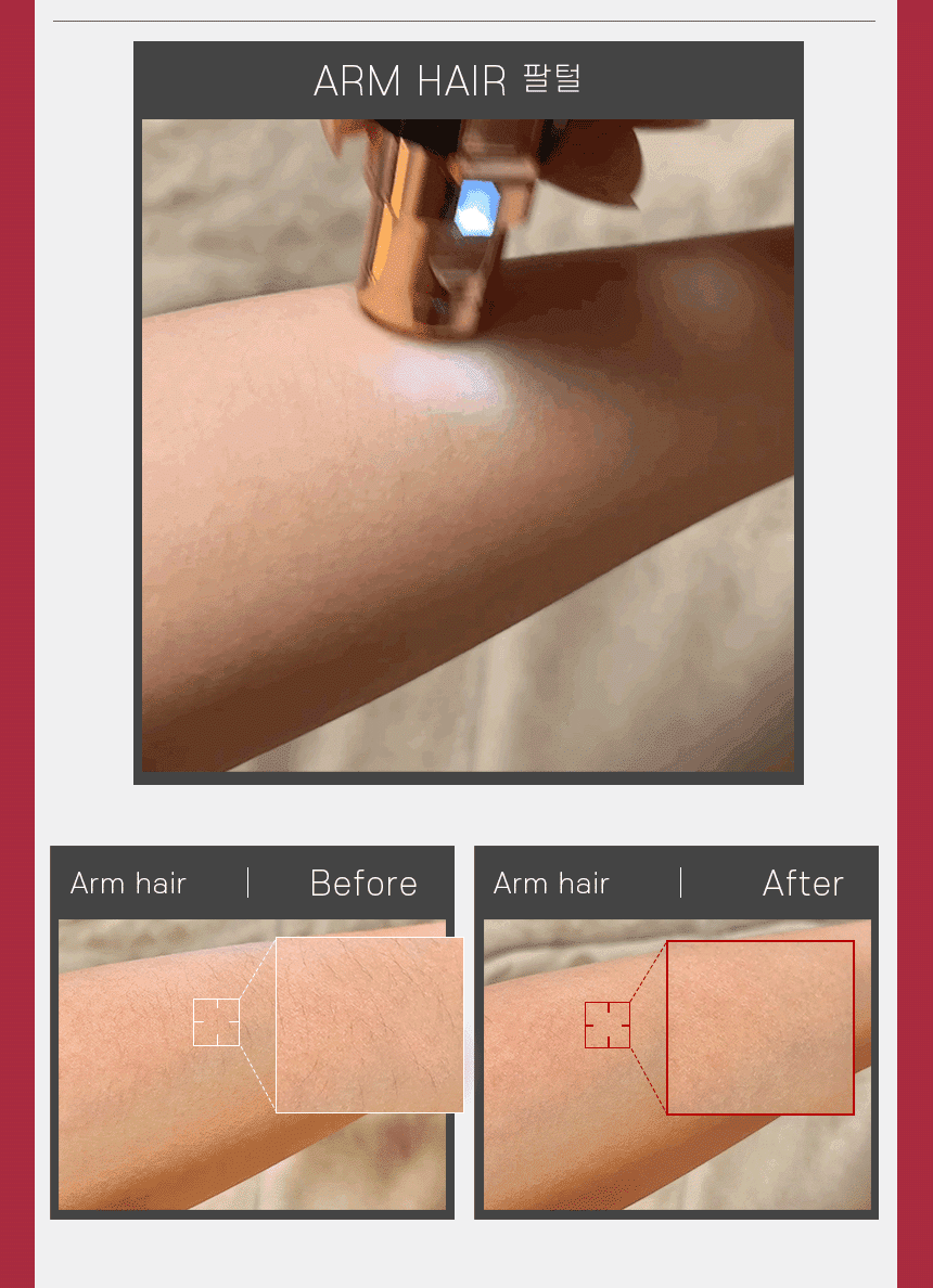 비포애프터-팔털