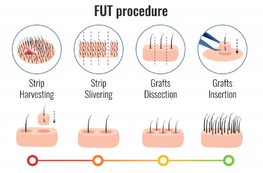 모발 이식 절개 방식에 대한 순서 설명