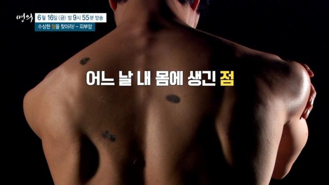 명의 수상한 &#39;점&#39;을 찾아라&#44; 피부암&#44; 악성 흑색종&#44; 예방&#44; 치료 방법