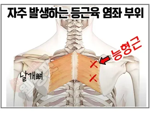 능형근-염좌로-인한-등통증