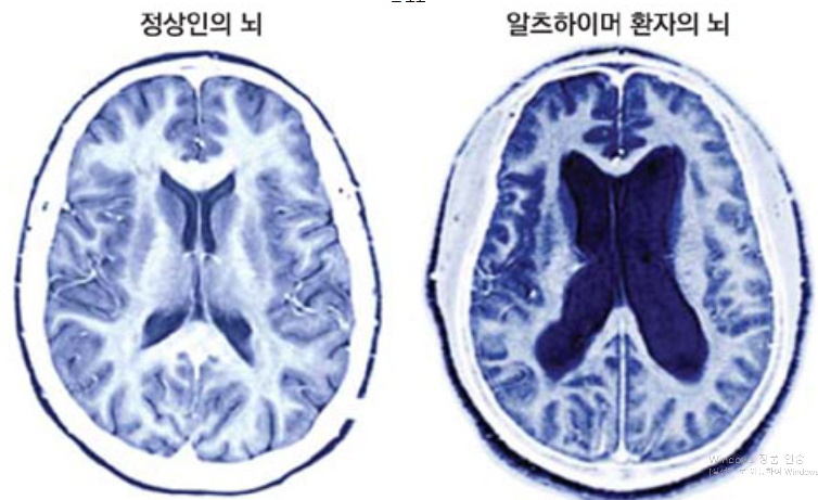 정상인의-뇌와-알츠하이머-환자의-뇌-비교-사진