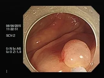 대장내시경 용종제거 후 식사 식단조절_5