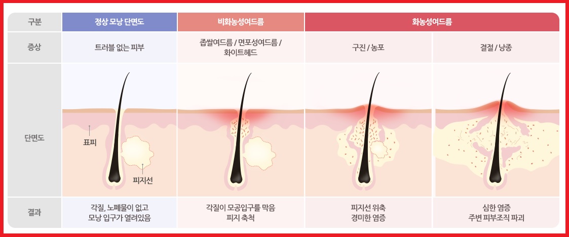 여드름 증상