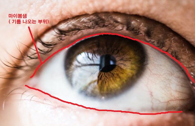 안구건조증 증상, 원인, 치료방법 및 예방