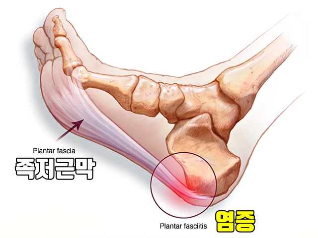 발뒤꿈치 찌릿 따끔 발바닥 전기 통증 족저근막염