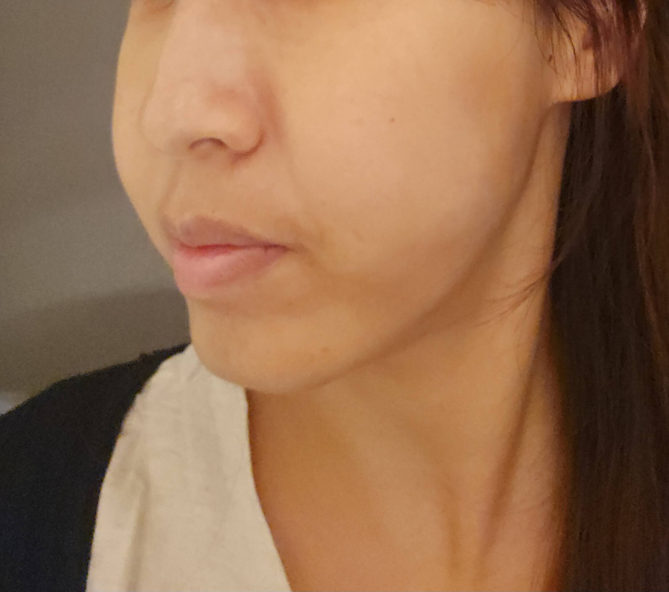리프팅