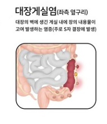  게실염 증상 (코로나 합병증)